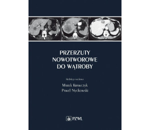 Przerzuty nowotworowe do wątroby