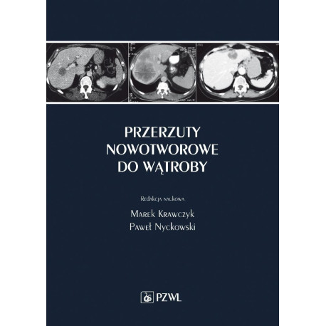 Przerzuty nowotworowe do wątroby