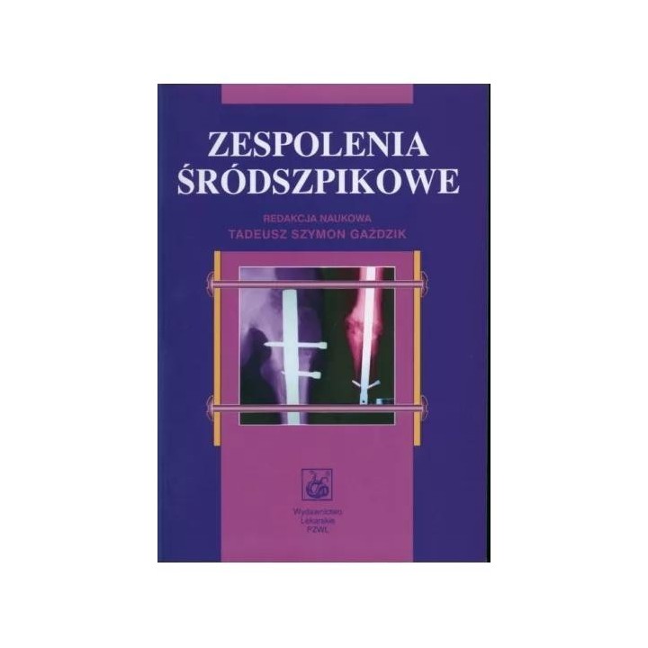 Zespolenia śródszpikowe