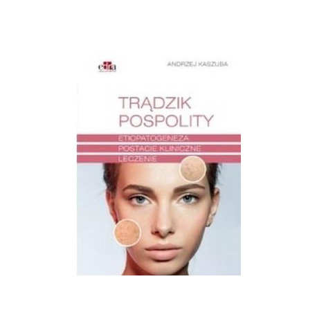 Trądzik pospolity. Etiopatogeneza. Postacie...