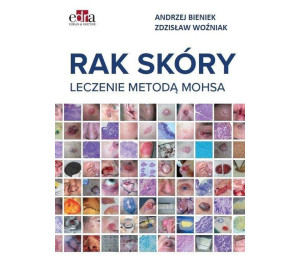 Rak skóry. Leczenie metodą Mohsa