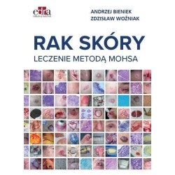 Rak skóry. Leczenie metodą Mohsa