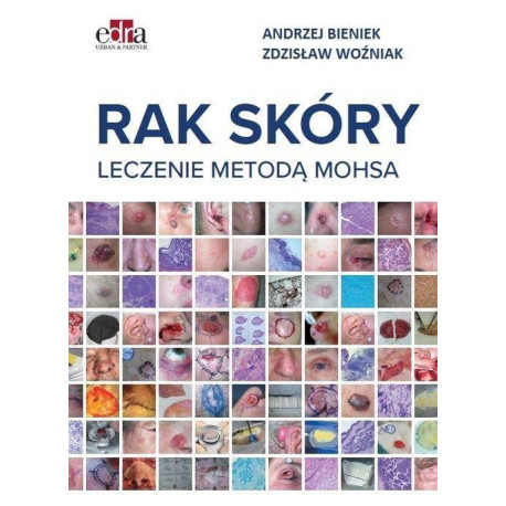 Rak skóry. Leczenie metodą Mohsa