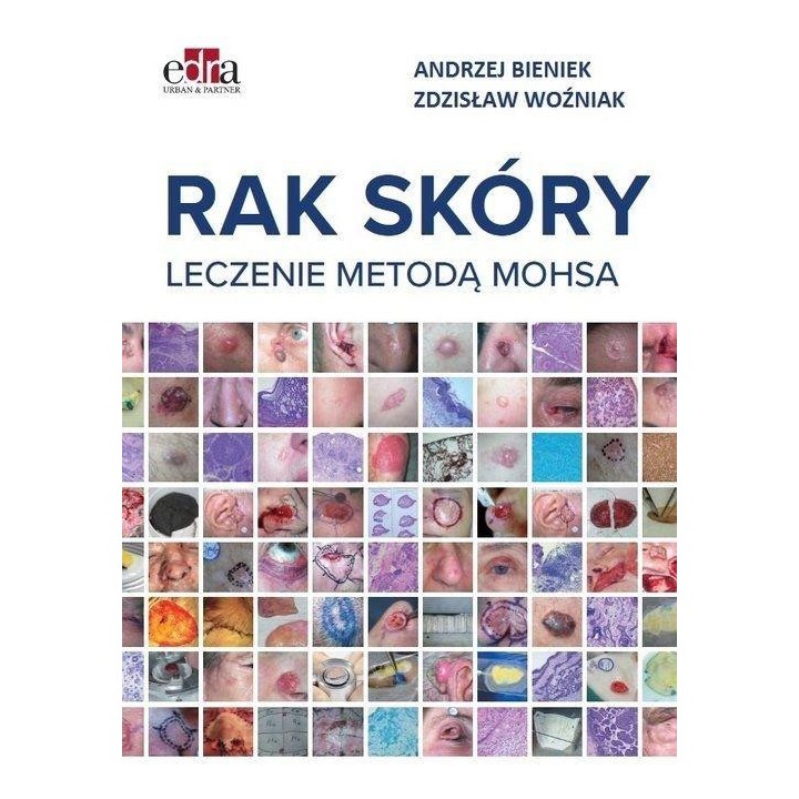 Rak skóry. Leczenie metodą Mohsa