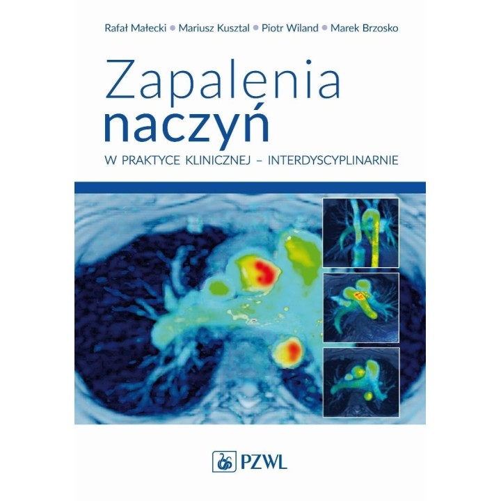 Zapalenia naczyń w praktyce klinicznej...